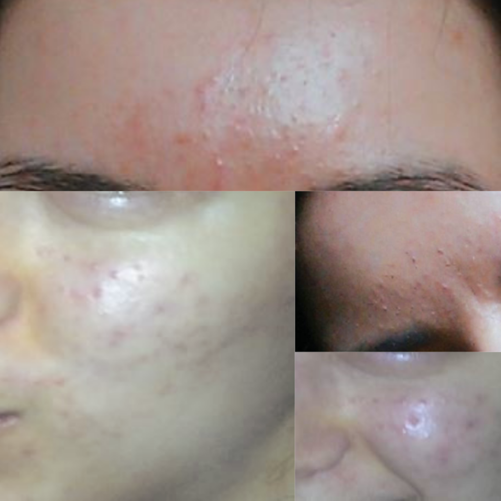 acne, woman with acne, breakouts, acne scars, hormonal acne, how to heal acne