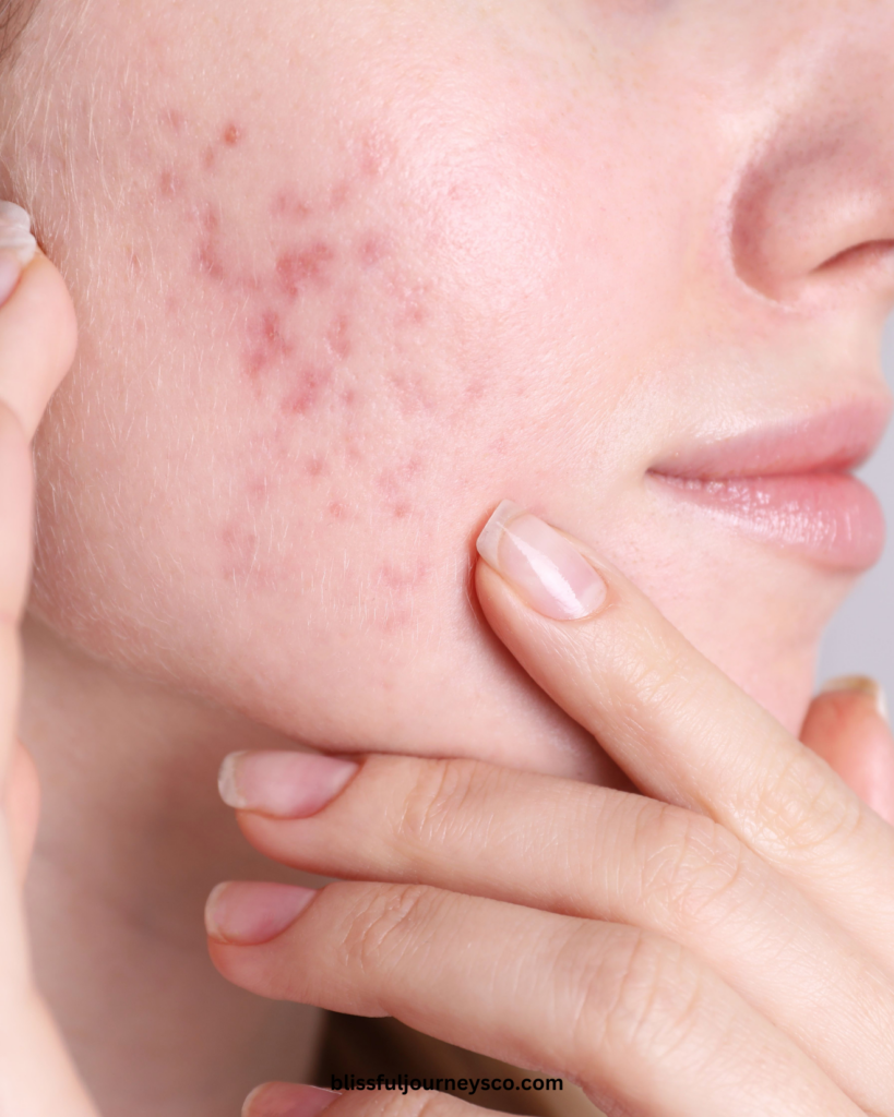 acne, woman with acne, breakouts, acne scars, hormonal acne, how to heal acne